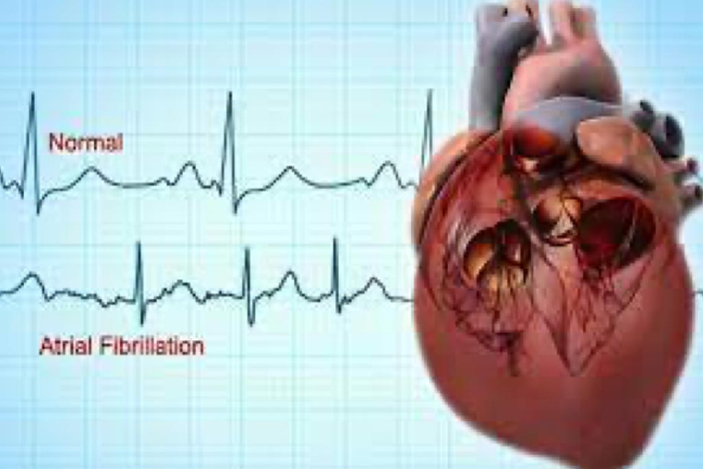 Atrial Fibrillation Ablation